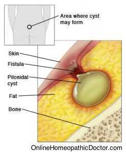 What is Anal Fistula