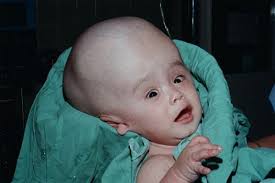 Best Homeopathic Treatment of Hydrocephalus Baby Image