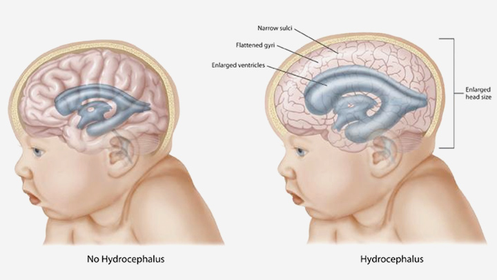 Difference Between Normal and Hydrocephalus Baby Image