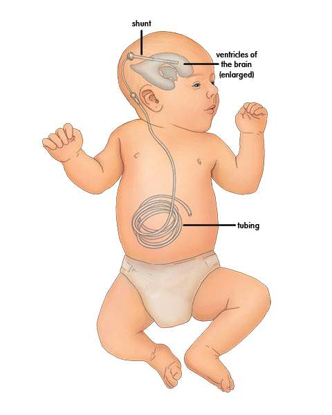 Как выглядит шунт. Шунт в голове у новорожденного. Вентрикулоперитонеостомия.