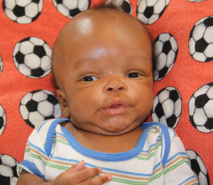 Best Homeopathic Treatment of Hydrocephalus Baby Enlarged Head