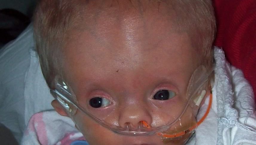 What is HydroCephalus Baby or Big Head Baby Issue