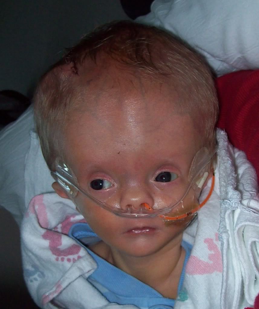 What is HydroCephalus Baby or Big Head Baby Issue