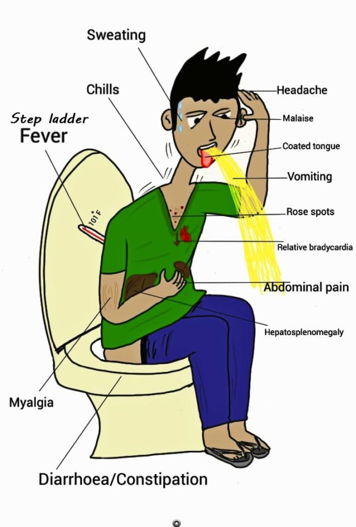 common signs and symptoms of typhoid fever image