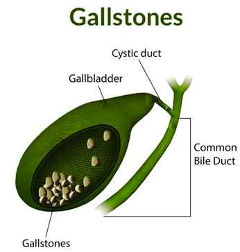 What Are GallBladder Stones