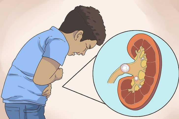 symptoms of kidney stones