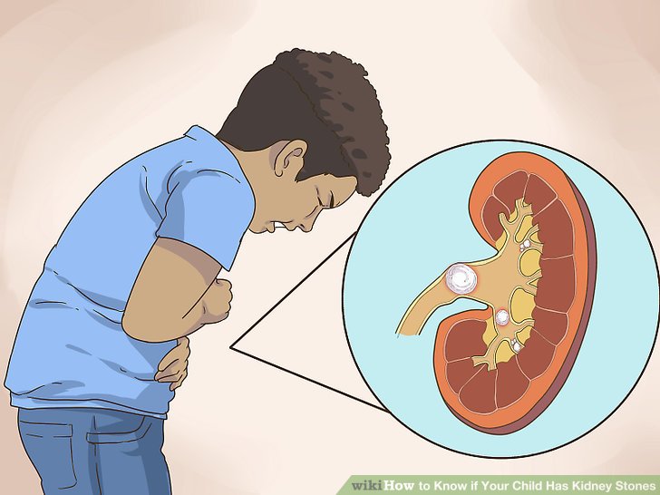 symptoms of kidney stones